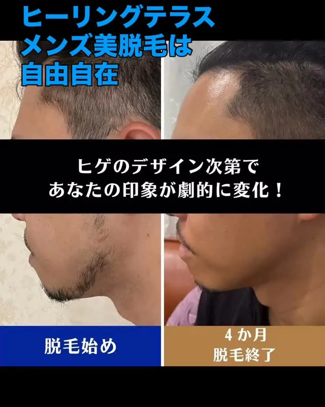 【9割の男性が知らない】　⭐️ヒゲ脱毛すると…